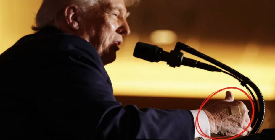 美国总统唐纳德·特朗普在一次活动中发表讲话时,右手上贴着创口贴。